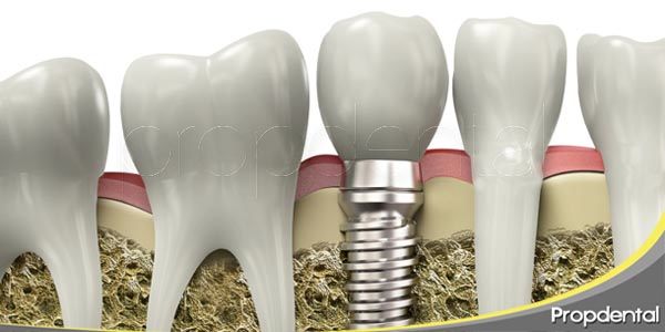 complicaciones habituales de los implantes dentales
