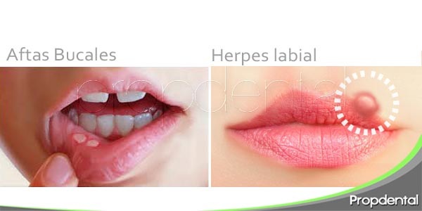 diferencias entre aftas bucales y herpes labial
