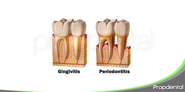 Diferencias entre la gingivitis y periodontitis