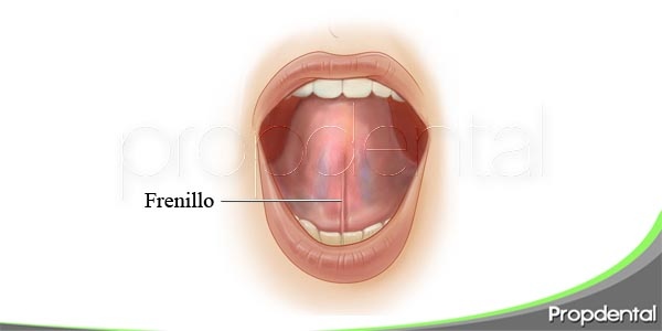 anquiloglosia o frenillo lingual corto