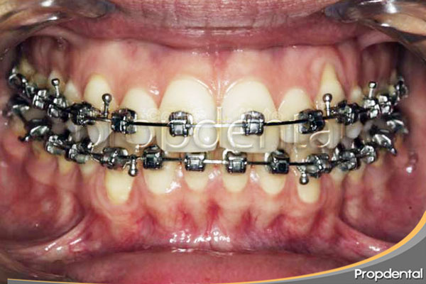 brackets damon