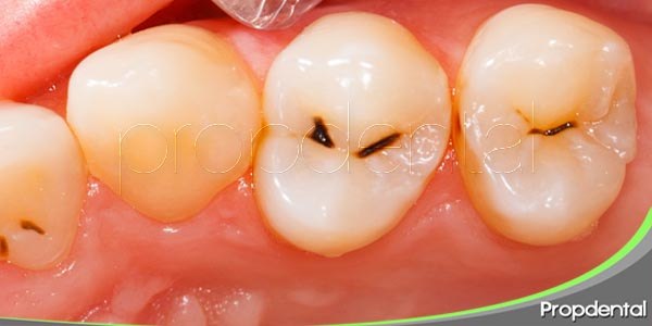 ¿qué causa la caries dental?