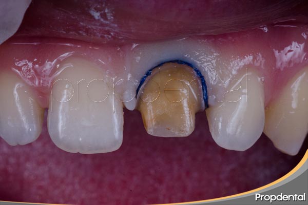 tallado dental para corona