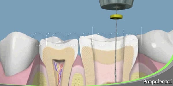 salvar la muela a través de una endodoncia
