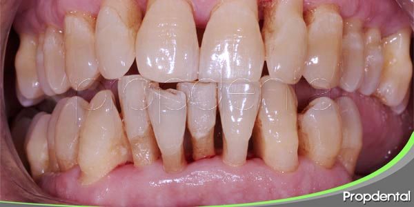 seis causas comunes de la periodontitis