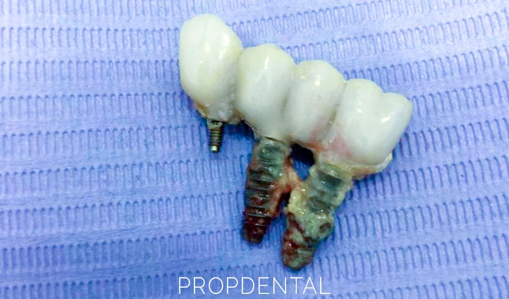 fracaso implantes dentales