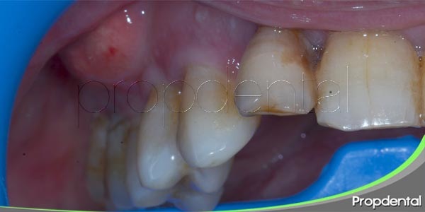 variedades de abscesos dentales