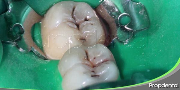 ¿cómo sé si tengo caries?