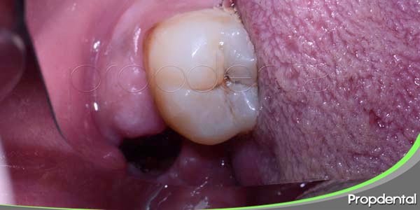 alveolitis