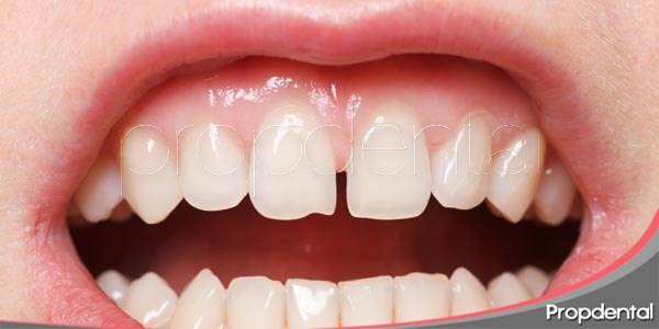 ¿Cómo cerrar el diastema y cuales sus causas?