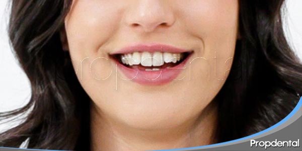 dientes torcidos