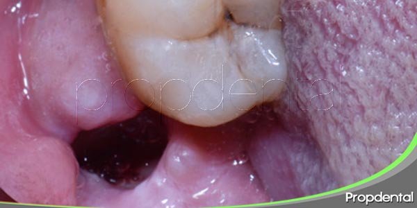 prevenir y tratar la alveolitis