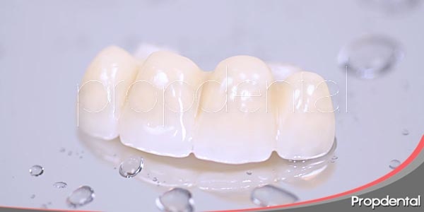 implantes Precios | ¿Puente dental vs implante?