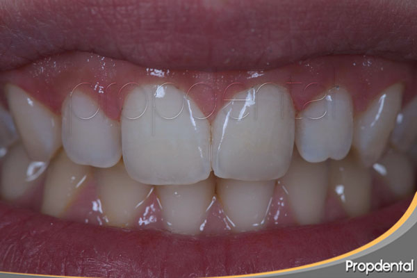 tratamiento hipoplasia dental