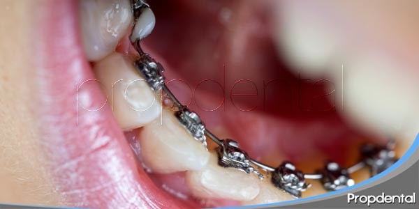 ortodoncia lingual y brackets linguales Barcelona