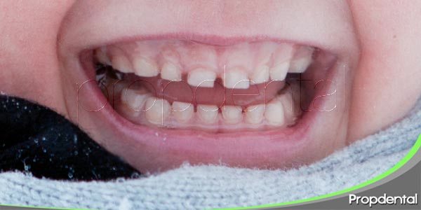 Bruxismo infantil: ¿qué puedo hacer si mi hijo rechina los dientes? 