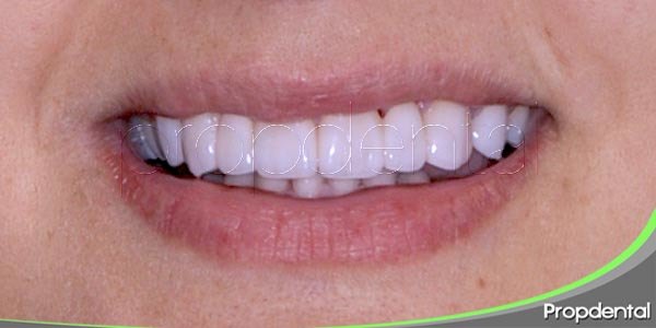 prótesis de circonio de los dientes anteriores para mejorar la estética de la sonrisa