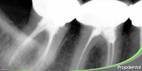 radiografía periapical vs radiografía oclusal