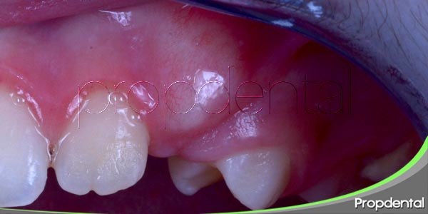 sintomas del absceso dental