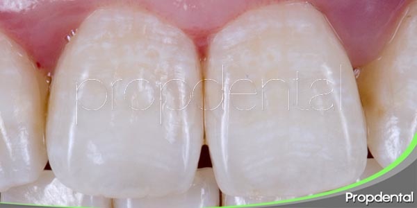 Manchas blancas en las uñas, ¿qué hay detrás?