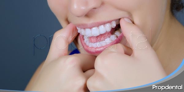 duración del tratamiento de invisalign