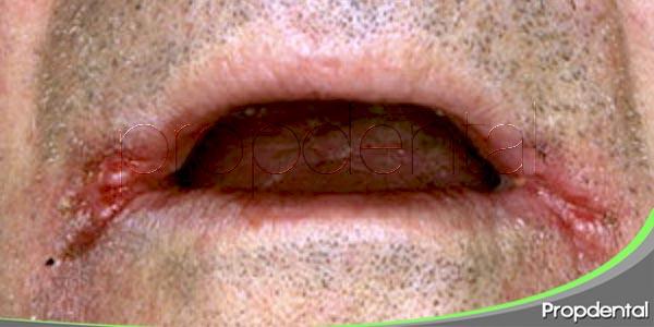 Queilitis Angular Diagnostico Y Tratamiento