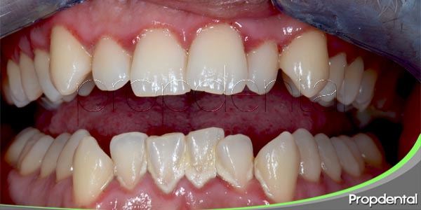soluciones para el apiñamiento dental