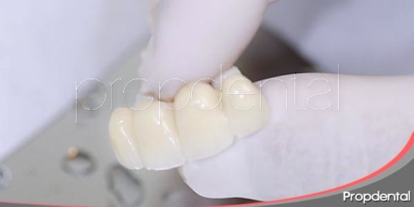 variedades de puentes dentales