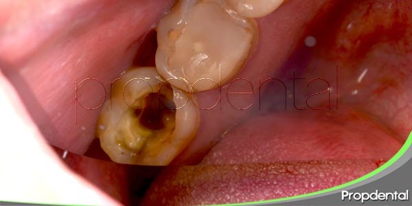 6 preguntas frecuentes acerca de la caries