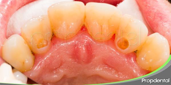 daño en la pulpa dental