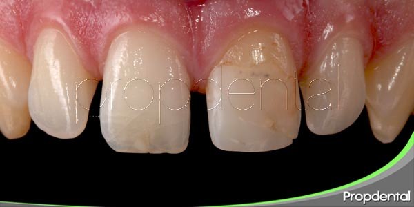 dientes agrietados