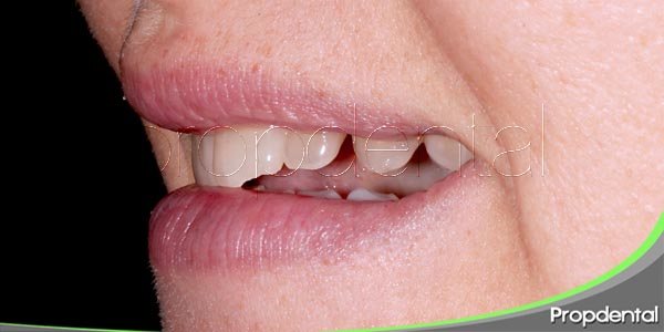 tratamiento para dientes rotos y agrietados