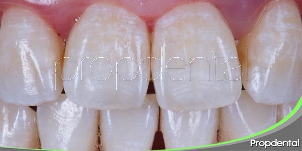 ¿Qué es la fluorosis dental?