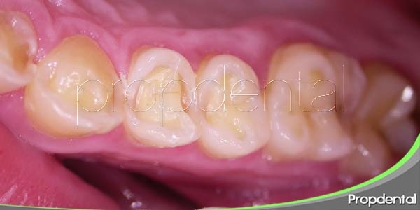 atrición dental