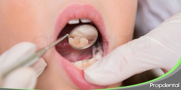 Caries en dientes de leche: ¿vale la pena empastarlos?