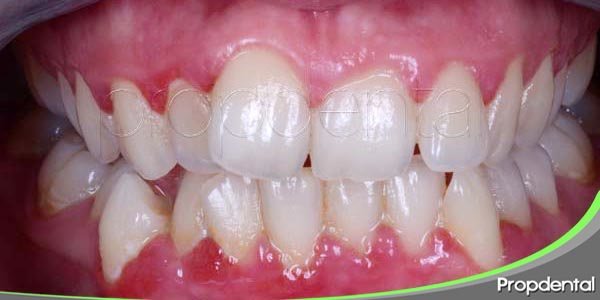 Causas de la gingivitis