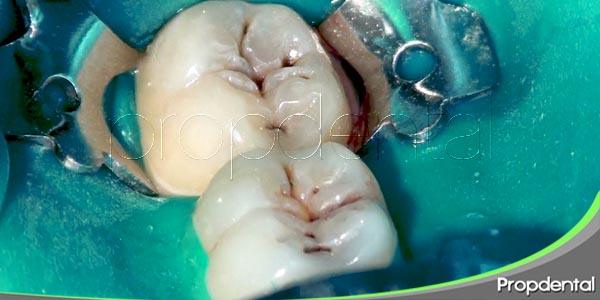 Consecuencias de la caries dental