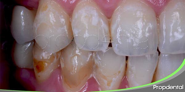 causas de Abrasión dental