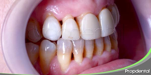 Motivos para tratar la recisión gingival