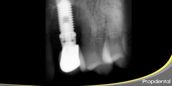 Problemas de los implantes dentales