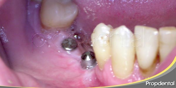 ¿Qué es la osteointegración?