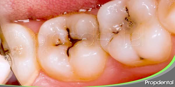 La caries dental: métodos habituales de restauración