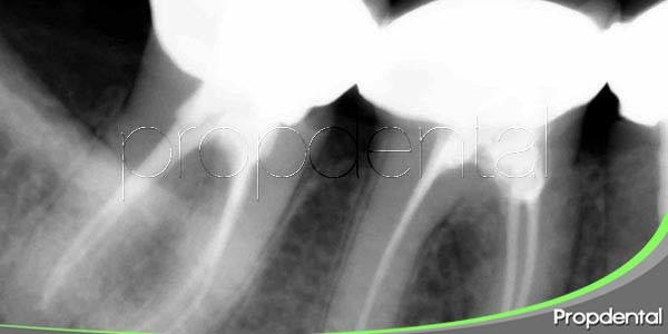 La radiografía periapical para el diagnóstico de caries debajo de una corona dental