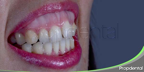 ¿Qué causa la sonrisa gingival? ¿Puede ser tratada?