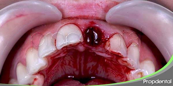 ¿Se puede prevenir la alveolitis?