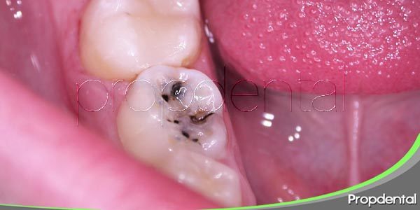 Caries dental. ¿Qué son y cómo se previenen?