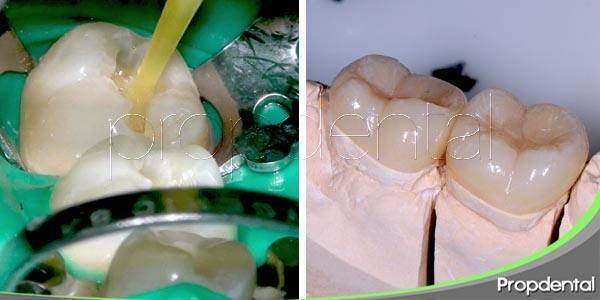 Diferencias entre empaste e incrustación dental