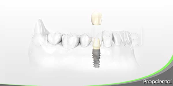 Implantes dentales: Sistema NobelActive
