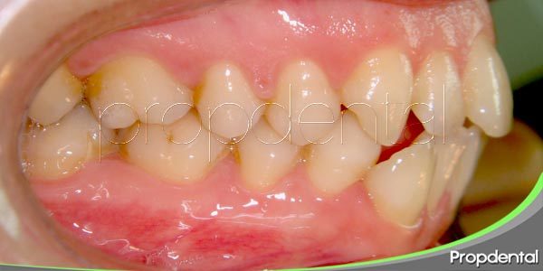 Los efectos de sufrir un trauma oclusal