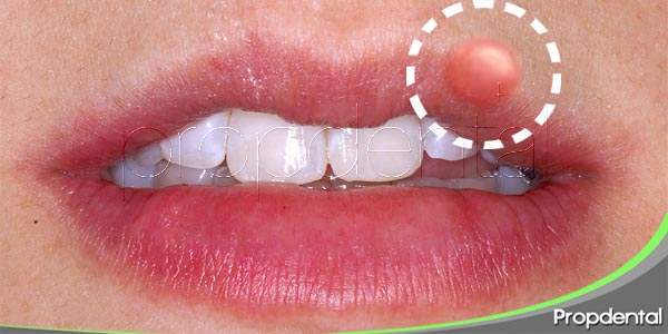 ¿Me ha salido un herpes bucal? ¿Cómo puedo curarlo?